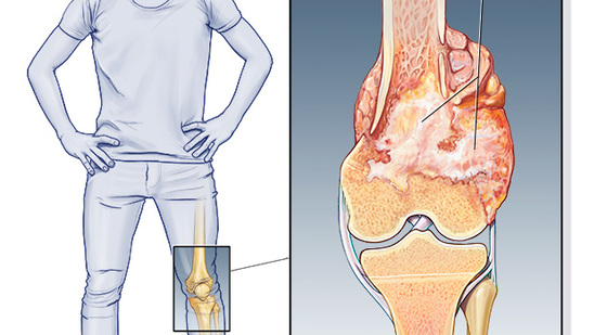 添翼2017-2018年ISPN/RN專業(yè)課&nbsp;35章&nbsp;腫瘤疾病